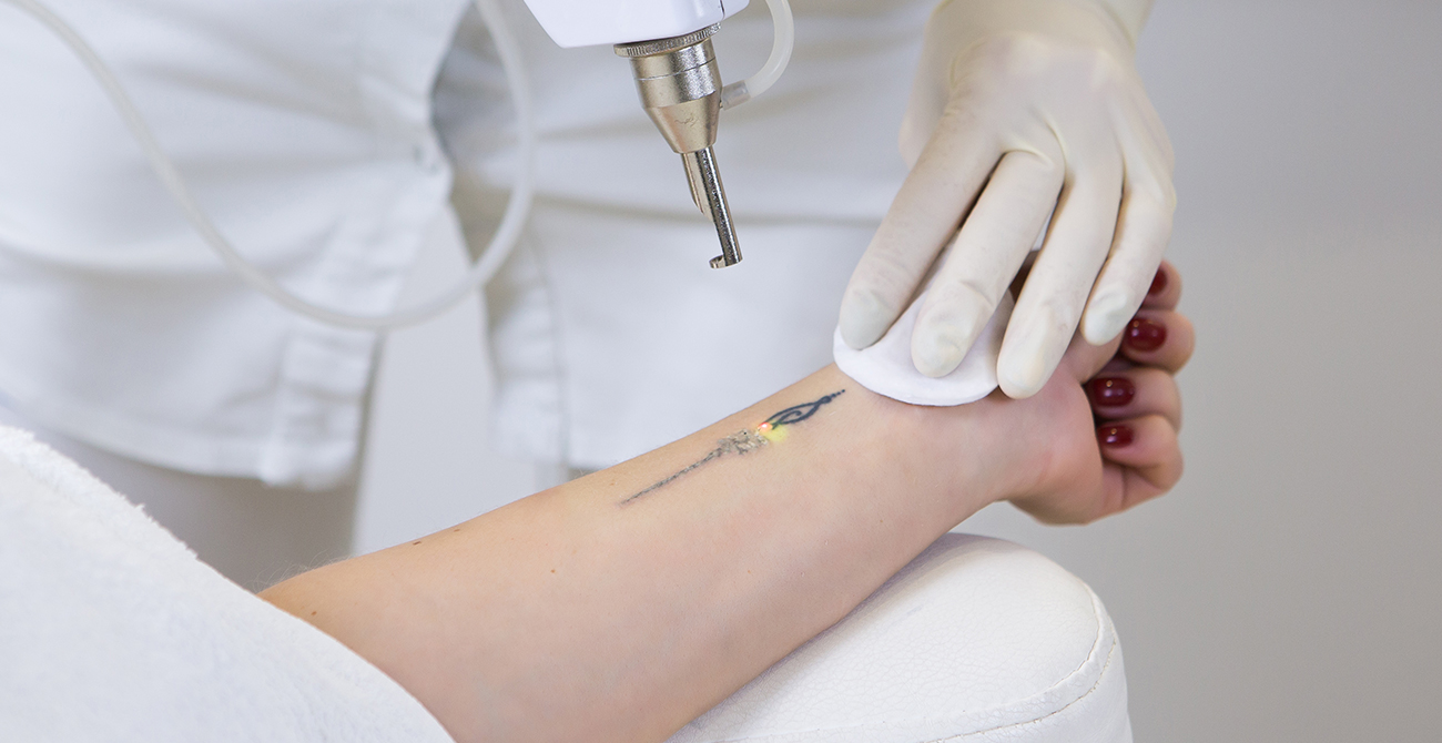 Tattoo removal
